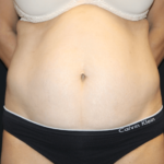 Tummy Tuck Before & After Patient #28999