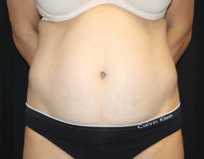 Tummy Tuck Before & After Patient #28999