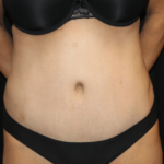 Tummy Tuck Before & After Patient #28999