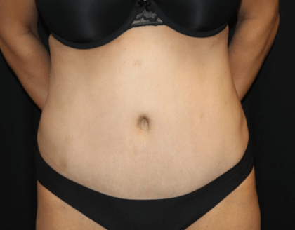 Tummy Tuck Before & After Patient #28999