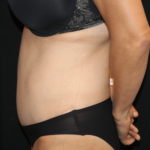 Tummy Tuck Before & After Patient #28999