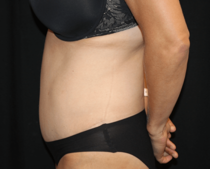 Tummy Tuck Before & After Patient #28999