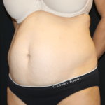 Tummy Tuck Before & After Patient #28999