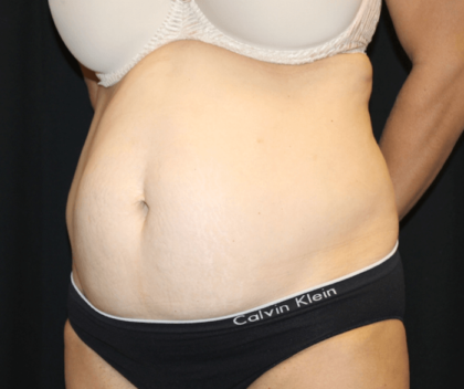 Tummy Tuck Before & After Patient #28999