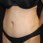 Tummy Tuck Before & After Patient #28999