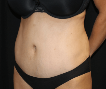 Tummy Tuck Before & After Patient #28999