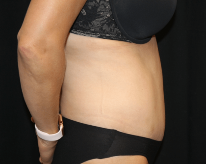 Tummy Tuck Before & After Patient #28999