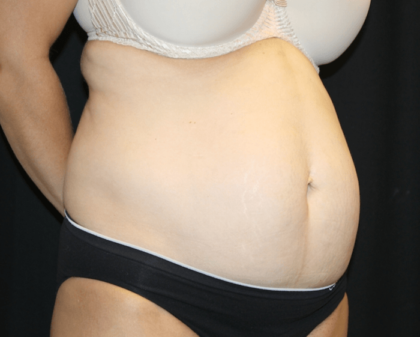 Tummy Tuck Before & After Patient #28999