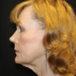 Facelift Before & After Patient #29010