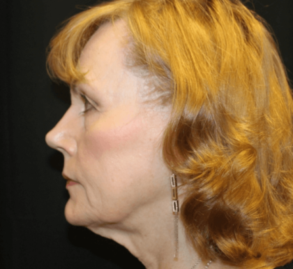 Facelift Before & After Patient #29010
