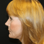 Facelift Before & After Patient #29010