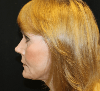 Facelift Before & After Patient #29010