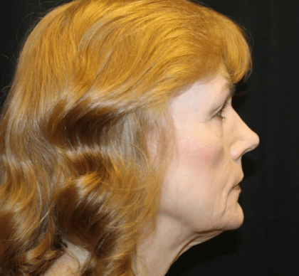 Facelift Before & After Patient #29010