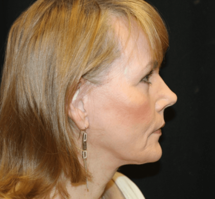 Facelift Before & After Patient #29010