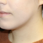 Kybella Before & After Patient #28984