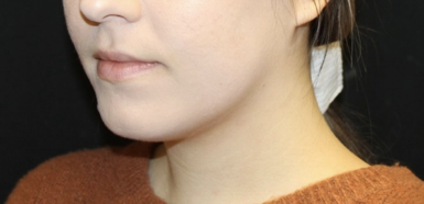 Kybella Before & After Patient #28984