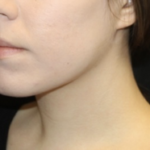 Kybella Before & After Patient #28984