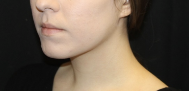 Kybella Before & After Patient #28984