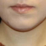 Kybella Before & After Patient #28984