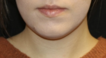 Kybella Before & After Patient #28984