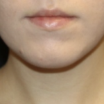 Kybella Before & After Patient #28984