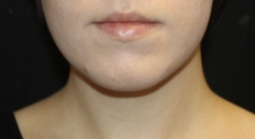 Kybella Before & After Patient #28984