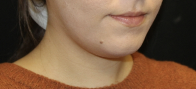 Kybella Before & After Patient #28984