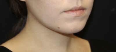 Kybella Before & After Patient #28984