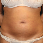 Tummy Tuck Before & After Patient #28972