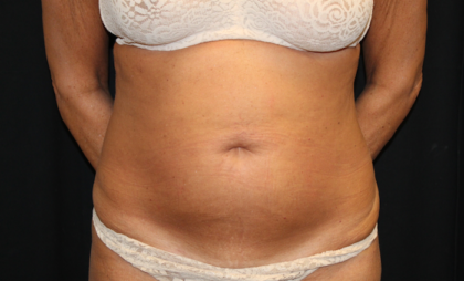 Tummy Tuck Before & After Patient #28972