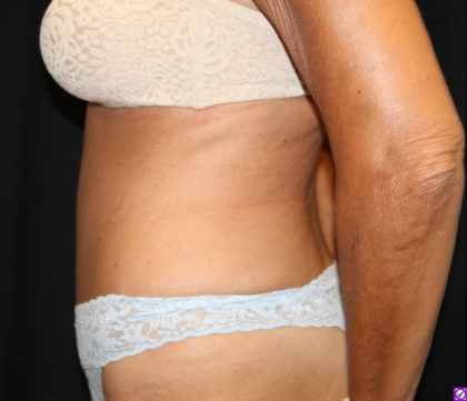 Tummy Tuck Before & After Patient #28972