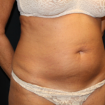 Tummy Tuck Before & After Patient #28972