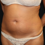 Tummy Tuck Before & After Patient #28972