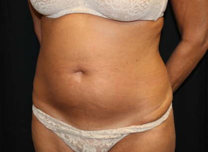 Tummy Tuck Before & After Patient #28972