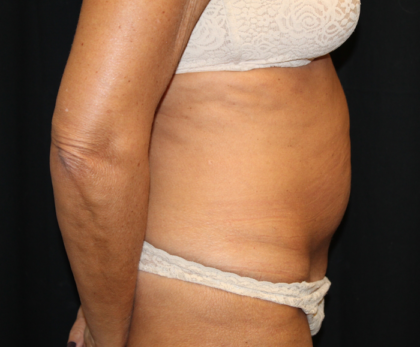 Tummy Tuck Before & After Patient #28972