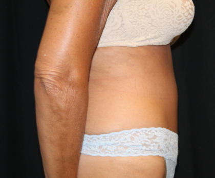 Tummy Tuck Before & After Patient #28972