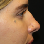 Rhinoplasty Before & After Patient #29021