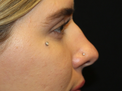 Rhinoplasty Before & After Patient #29021