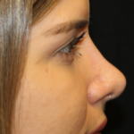 Rhinoplasty Before & After Patient #29021