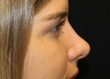 Rhinoplasty Before & After Patient #29021