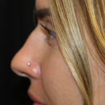 Rhinoplasty Before & After Patient #29021