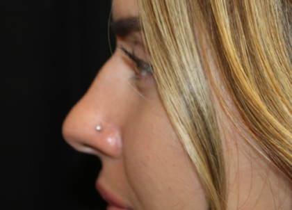 Rhinoplasty Before & After Patient #29021