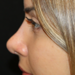 Rhinoplasty Before & After Patient #29021