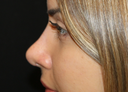 Rhinoplasty Before & After Patient #29021