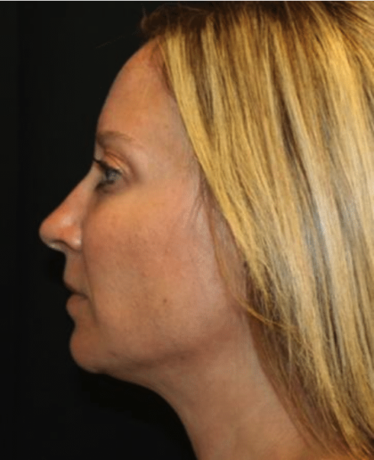 Injectable Fillers Before & After Patient #29081