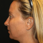 Injectable Fillers Before & After Patient #29081