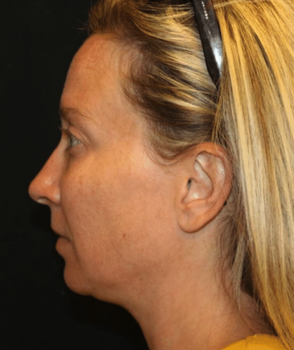 Injectable Fillers Before & After Patient #29081