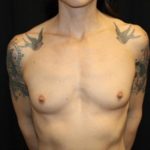 Breast Augmentation - Round Silicone Implants Before & After Patient #29033