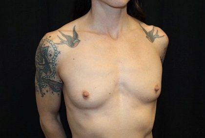 Breast Augmentation - Round Silicone Implants Before & After Patient #29033