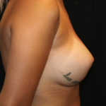 Breast Augmentation - Shaped Silicone Implants Before & After Patient #29070